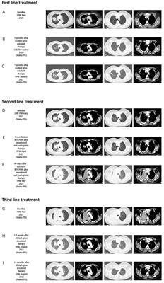 Rechallenge with EGFR-TKI after failure of immunotherapy is considered an effective treatment for advanced lung adenocarcinoma patients with EGFR exon 19 deletion: a case report